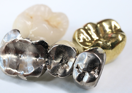 歯科用金属(金歯・銀歯など)